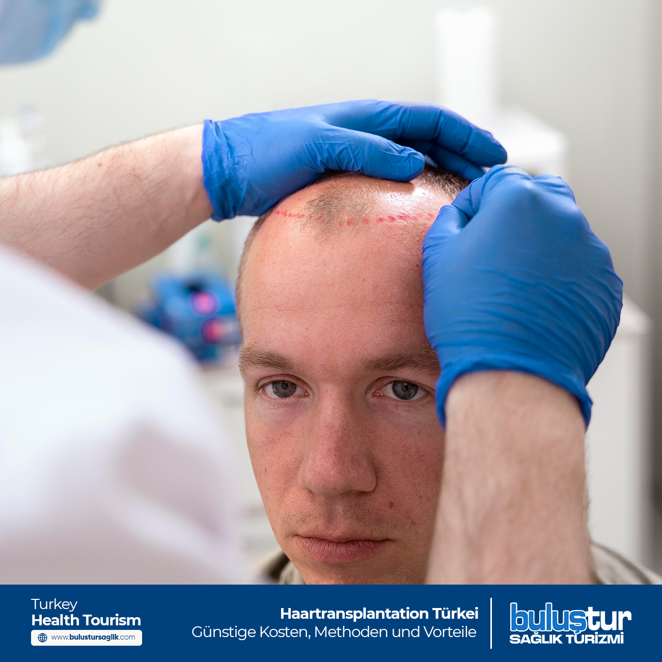 Haartransplantation Türkei: Günstige Kosten, Methoden und Vorteile | Sağlık Hizmetleri Türkiye Haartransplantation Türkei: Günstige Kosten, Methoden und Vorteile